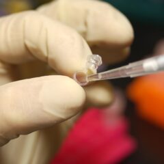 Doenças raras: como conseguir diagnóstico e tratamento pelo SUS